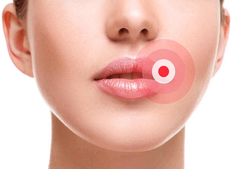 Cold sore treatments available at Romeoville Smiles in Romeoville, IL