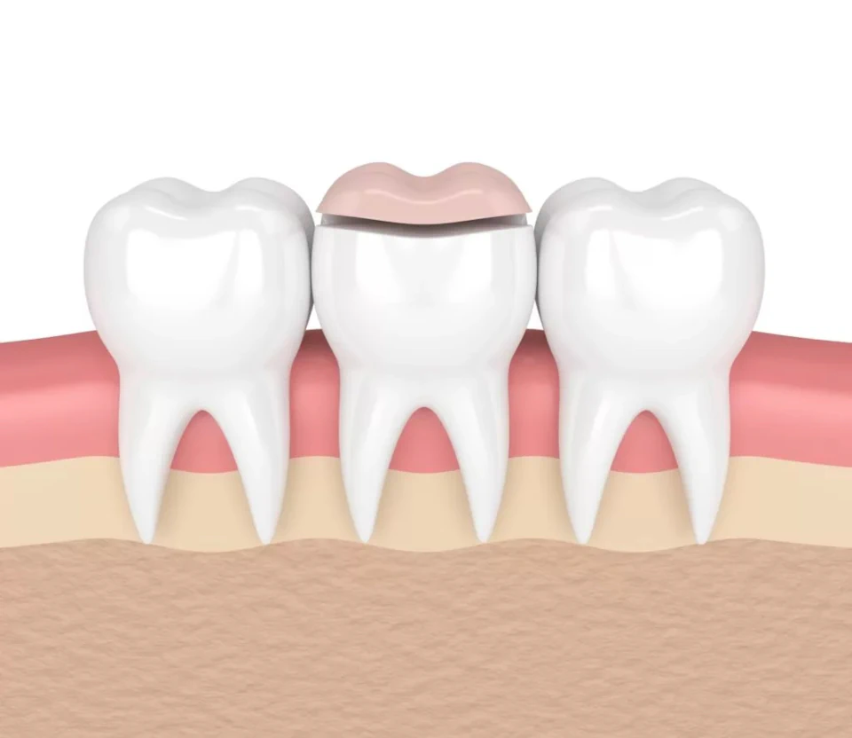 Dental inlays and dental onlays available at Romeoville Smiles in Romeoville, IL