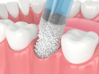 Dental bone grafting at Romeoville Dental Center shows graft material being placed into the jawbone to restore lost bone and support future dental implants.